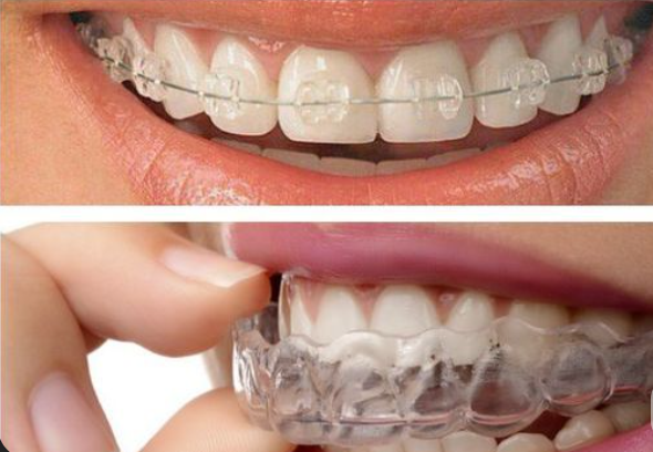 Comparação entre aparelho ortodôntico fixo e aparelho invisível Invisalign